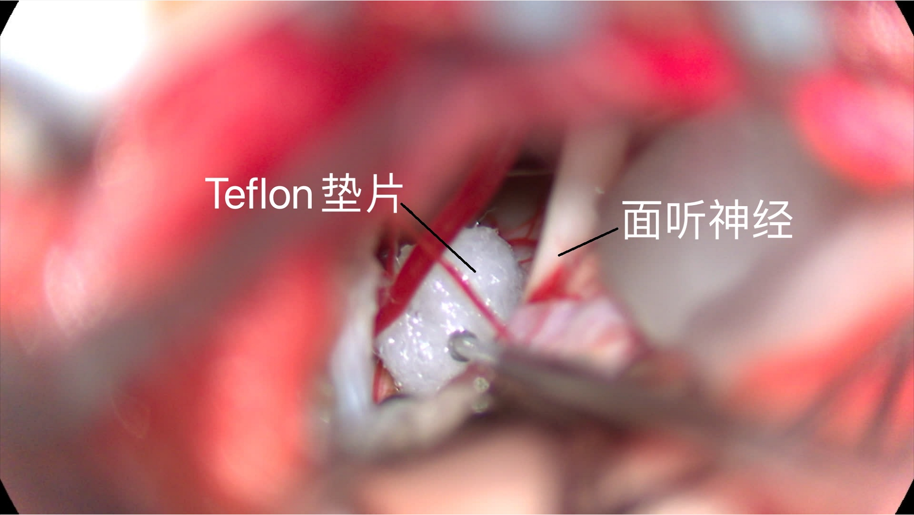 华安脑科医院成功开展首例面肌痉挛显微血管减压术